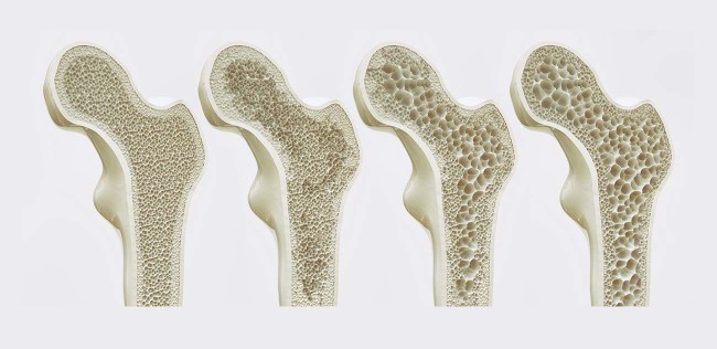 Verlauf von Osteoporose: Zunehmend löchrige Knochenstruktur