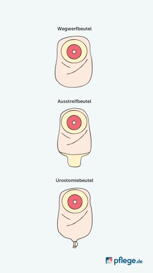 Stoma-Versorgung