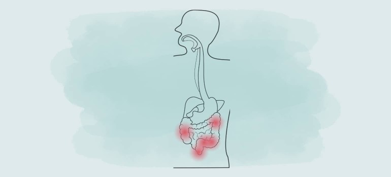 Colitis ulcerosa