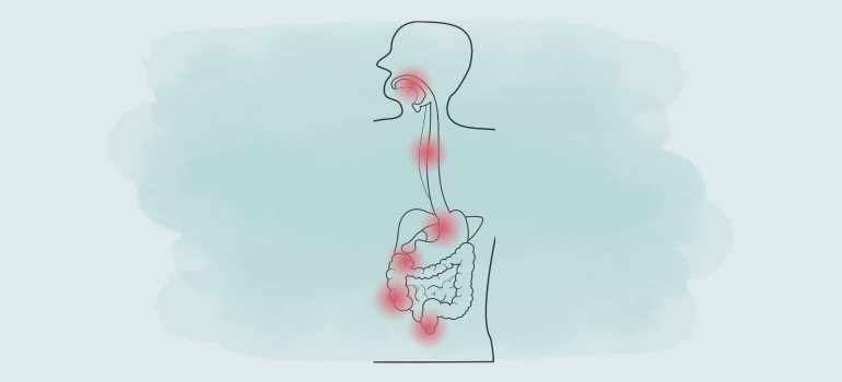 Morbus Crohn