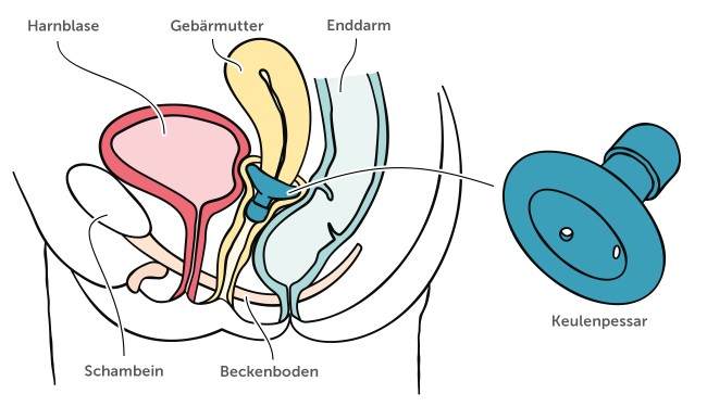 Keulenpessar