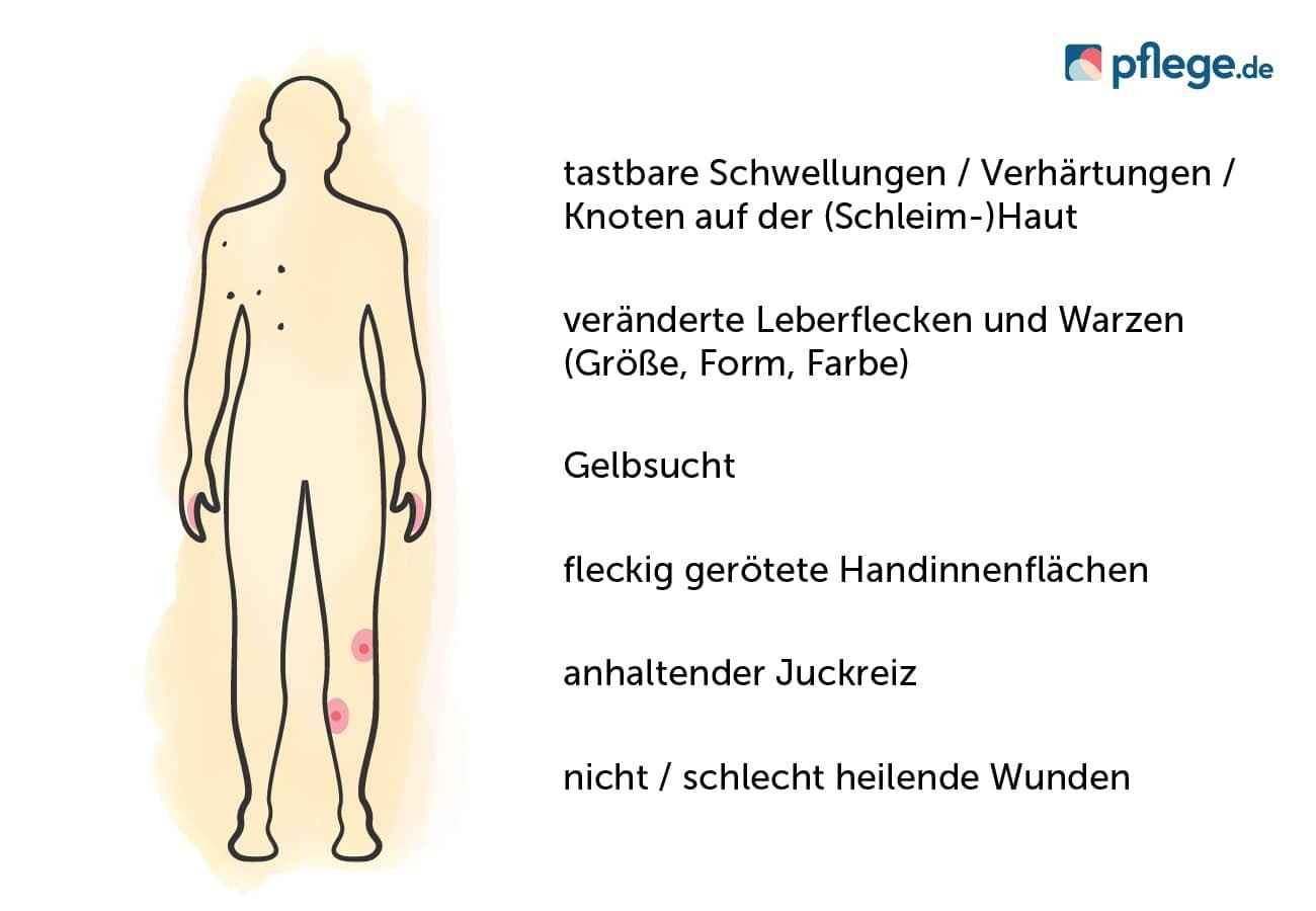 Mögliche Anzeichen für eine Krebserkrankung der Haut