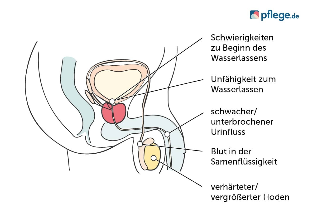 Mögliche Anzeichen für eine Krebserkrankung im männlichen Genital-Trakt