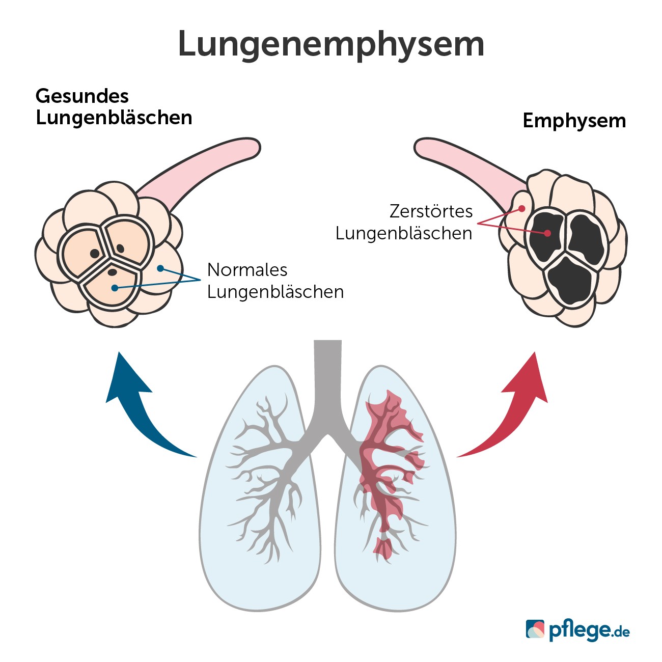 Lungenemphysem