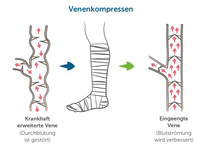 Venenkompression zur Thromboseprophylaxe